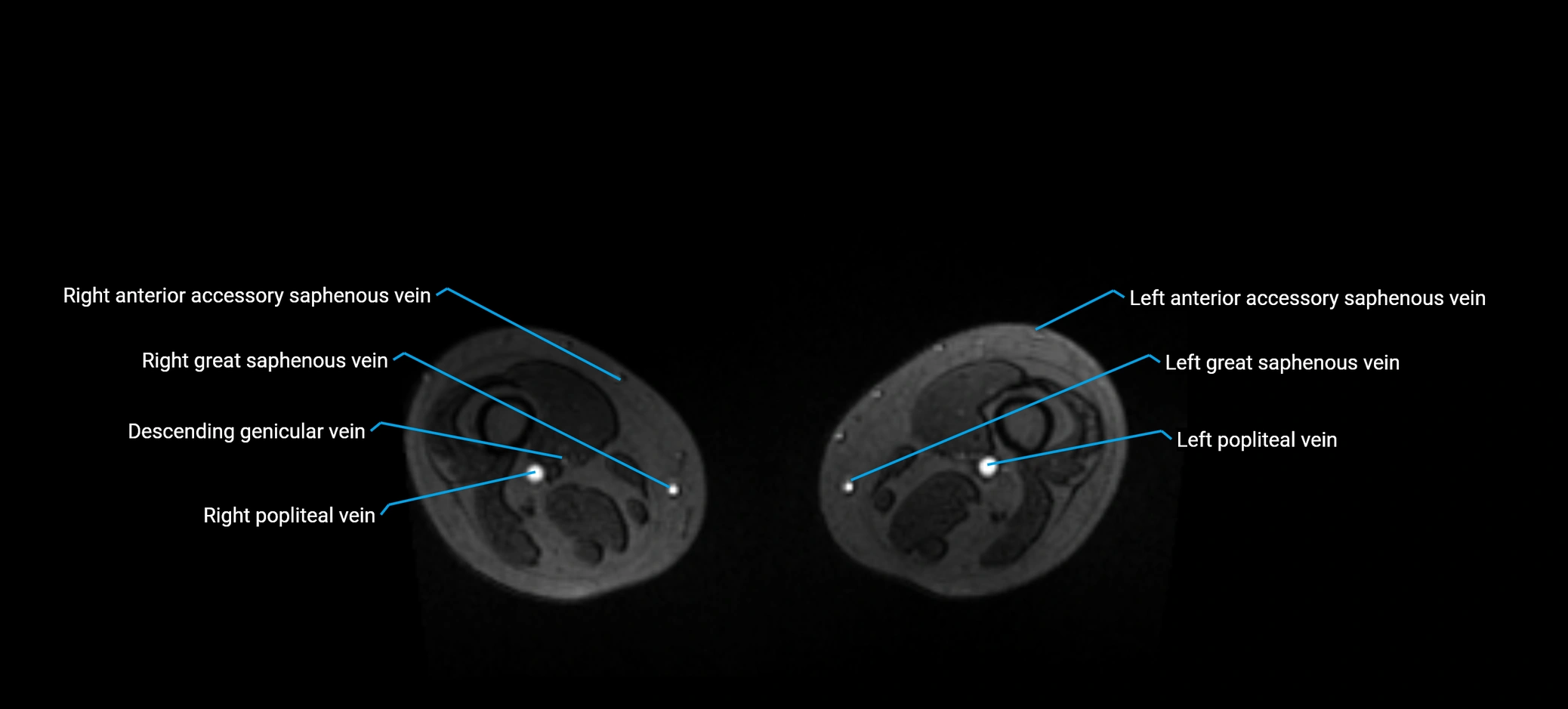 MRV abdomen pelvis & lower limb axial cross sectional anatomy labelled MRI image 325.webp